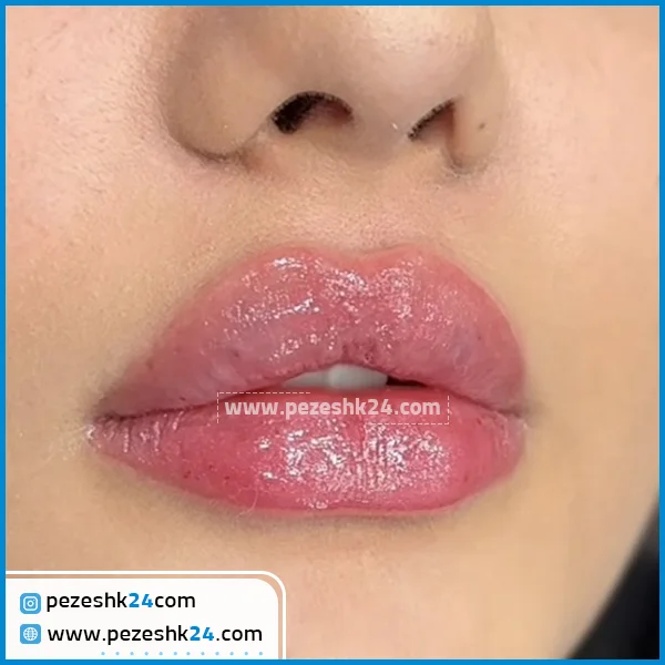 تزریق ژل لب دکتر سلطانی