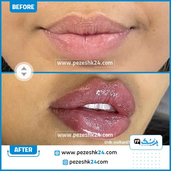 قبل و بعد تزریق فیلر دکتر حمیده سلطانی