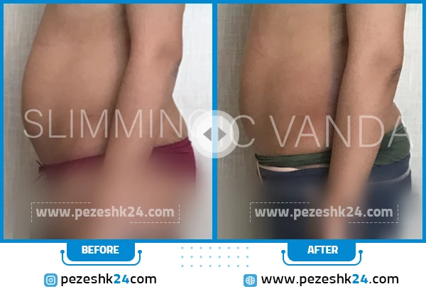 قبل و بعد لاغری در مرکز وندا تهران