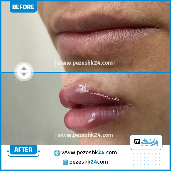 قبل و بعد از تزریق ژل دکتر موسوی