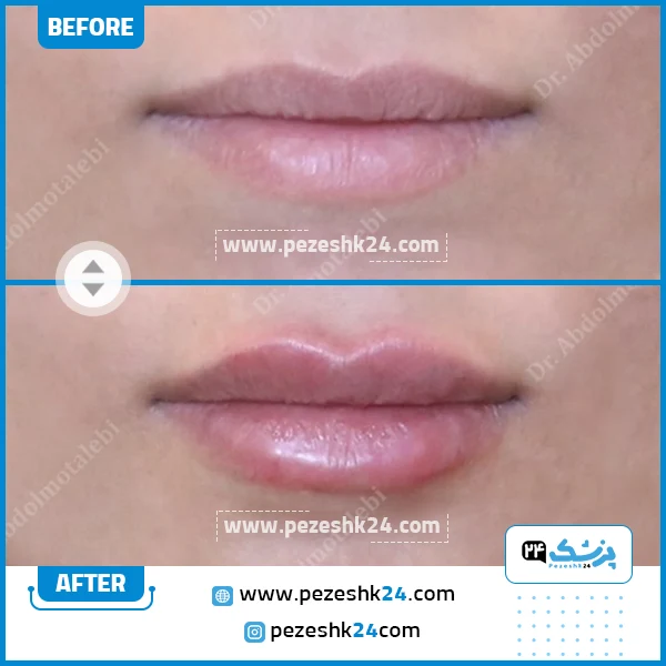 قبل و بعد تزریق ژل لب دکتر عبدالمطلبی تهران