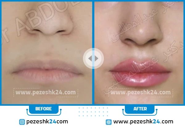 قبل و بعد تزریق ژل لب دکتر سیدرضا عبدالمطلبی