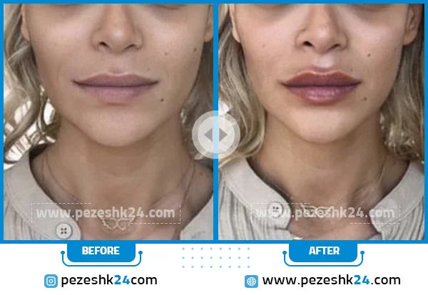 قبل و بعد از تزریق ژل لب دکتر فاضلی