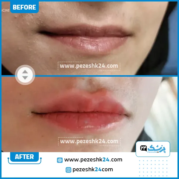 قبل و بعد تزریق فیلر لب دکتر رحیمی
