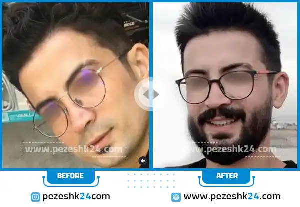 قبل و بعد جراحی کاشت ریش کلینیک مدرن
