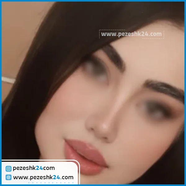 عمل زیبایی بینی استخوانی در مشهد