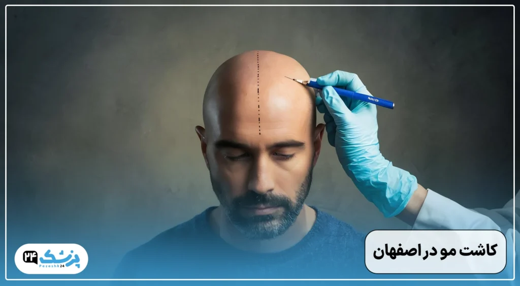 کاشت مو در اصفهان