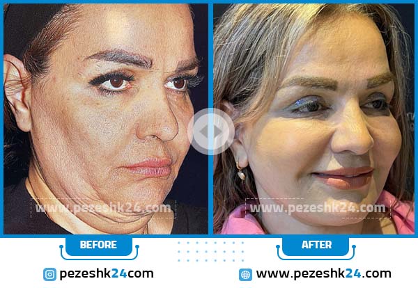 قبل و بعد لیفت صورت دکتر هادی امالی امیری در تهران