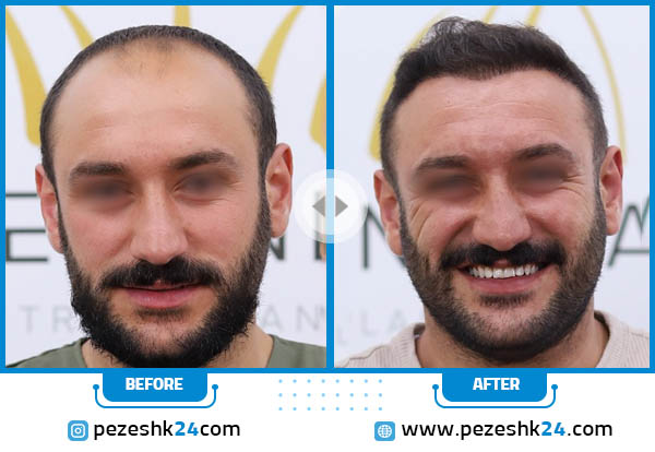 قبل و بعد کاشت مو تهران