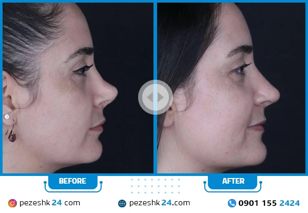 نمونه جراحی زیبایی بینی