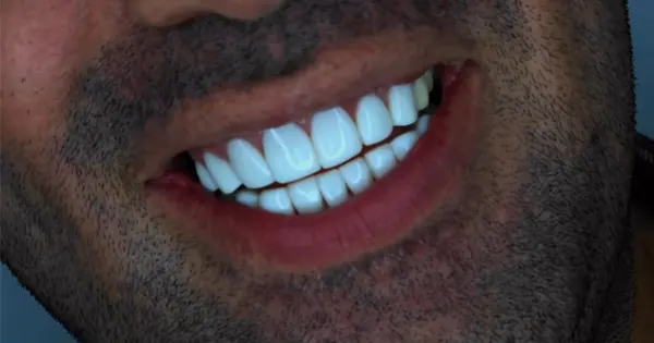 ایمپلنت دندان غرب تهران