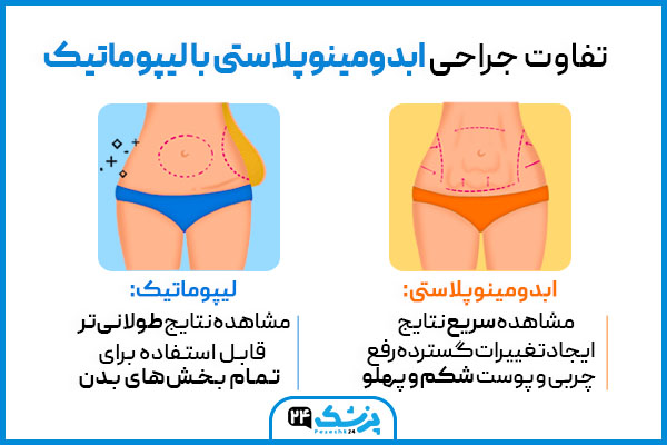 تفاوت های جراحی ابدومینوپلاستی با لیپوماتیک