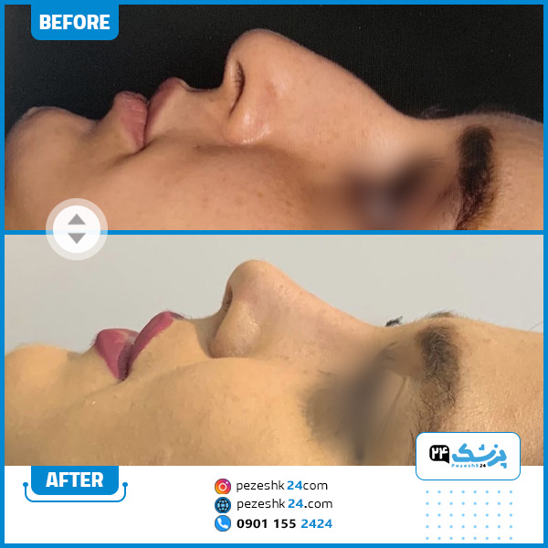 قبل و بعد عمل بینی دکتر محمدی