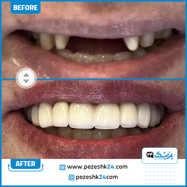 قبل و بعد کاشت دندان دکتر خلجیان