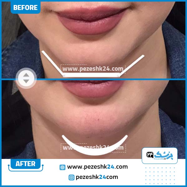نمونه فیلر چانه دکتر میراحد موسوی