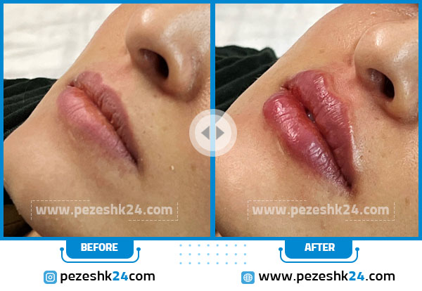 قبل و بعد تزریق ژل لب دکتر دریانی