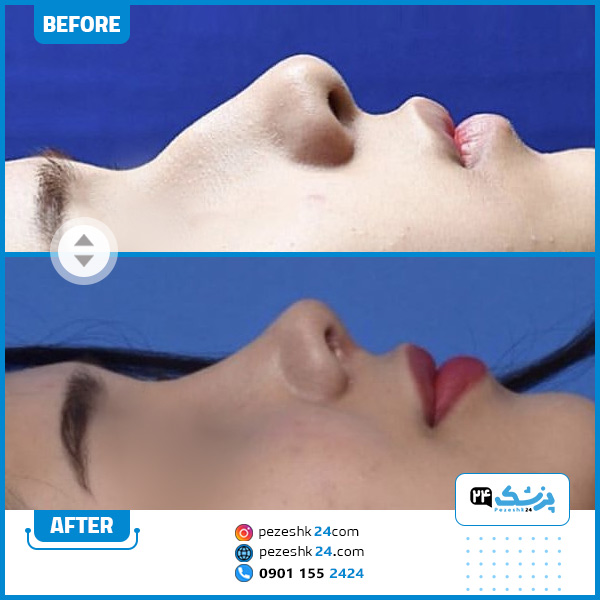 قبل و بعد عمل بینی دکتر عقیلی