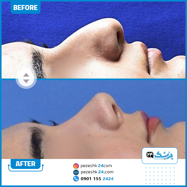 قبل و بعد از عمل بینی دکتر عقیلی
