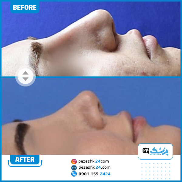 قبل و بعد از عمل بینی دکتر عقیلی در گرگان