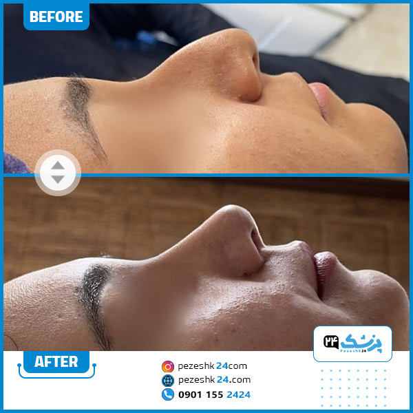 قبل و بعد عمل بینی دکتر اسلامی