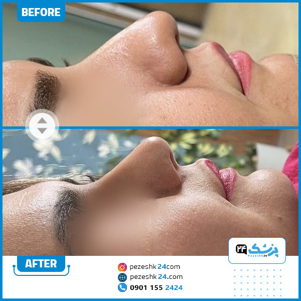 قبل و بعد عمل بینی دکتر اسلامی گرگان