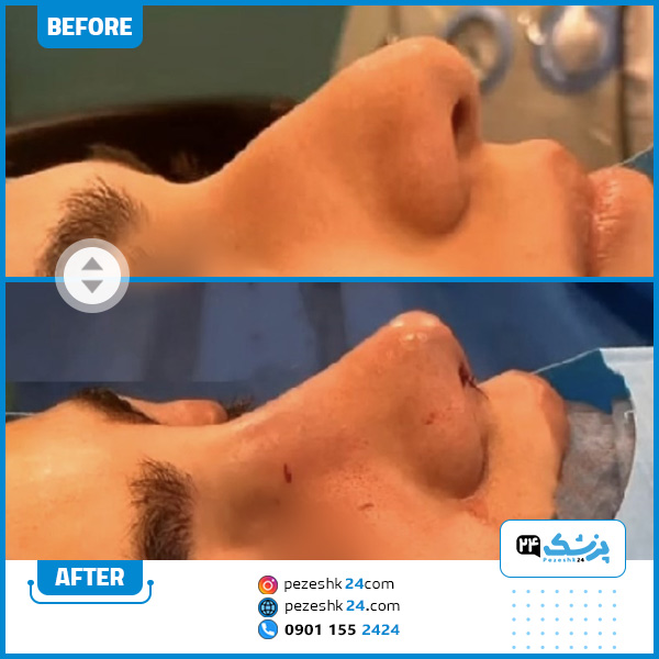 قبل و بعد عمل بینی دکتر حسینی خواه
