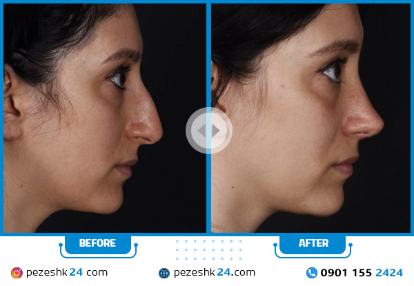 قبل و بعد عمل بینی استخوانی گرگان