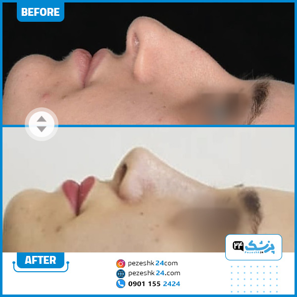 قبل و بعد عمل بینی دکتر ناعمی