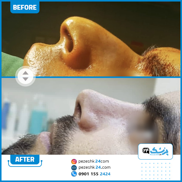 قبل و بعد عمل بینی دکتر ناعمی گرگان