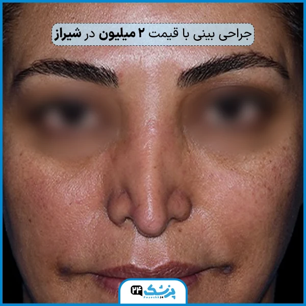 عمل بینی با قیمت ۲ میلیون در شیراز