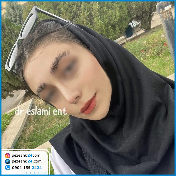 جراحی بینی دکتر یعقوبی