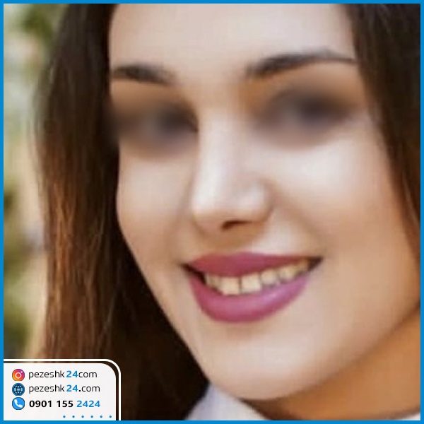 عمل زیبایی بینی دکتر اسلامی گرگان