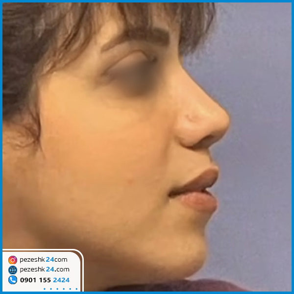 عمل بینی دکتر حسینی خواه گرگان