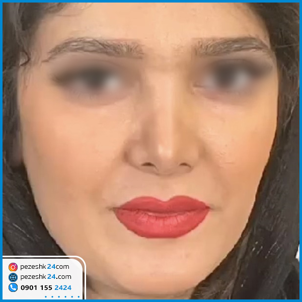 عمل بینی دکتر حسینی خواه در گرگان