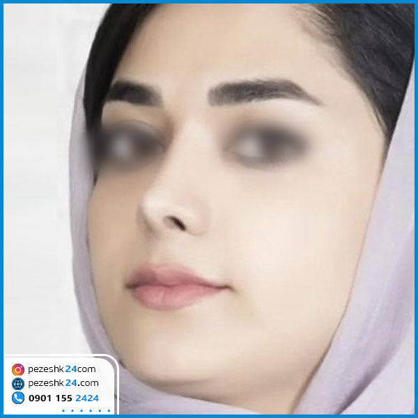 عمل بینی دکتر رستمی گرگان