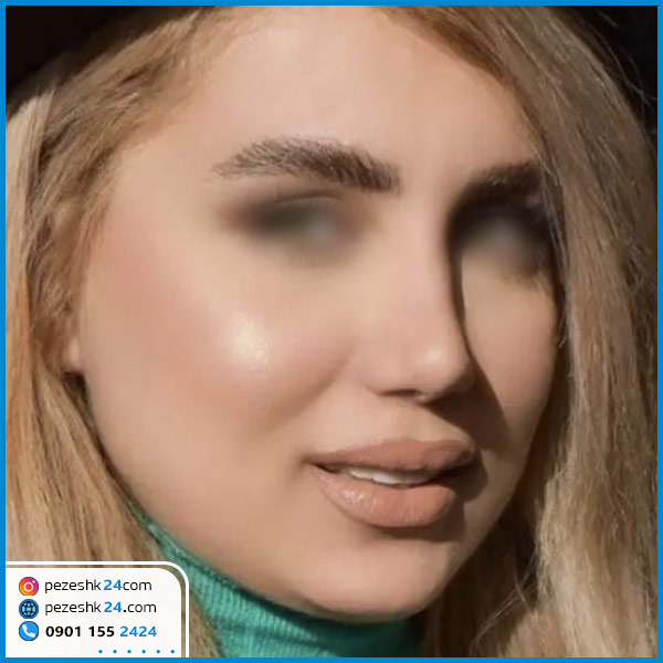 عمل بینی دکتر رستمی در گرگان