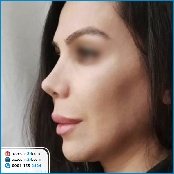 عمل بینی دکتر یعقوبی