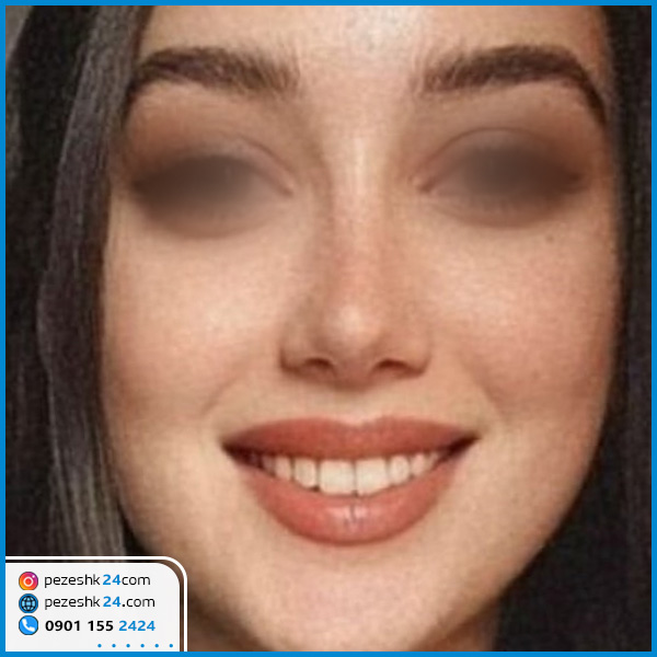 جراحی بینی دکتر یعقوبی