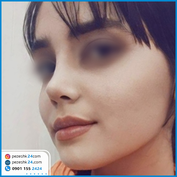 عمل جراحی بینی دکتر یعقوبی