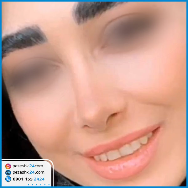 عمل بینی دکتر عالیشاهی