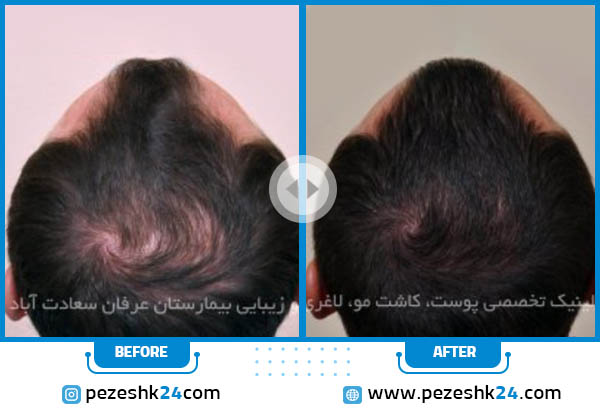 قبل و بعد پی آر پی مو کلینیک عرفان