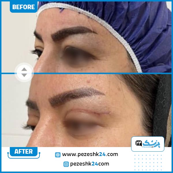 قبل و بعد بلفاروپلاستی در کلینیک اوینا