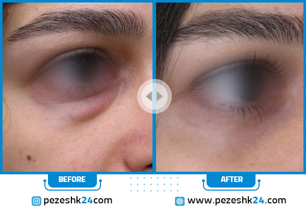 قبل و بعد بلفاروپلاستی در کلینیک شید