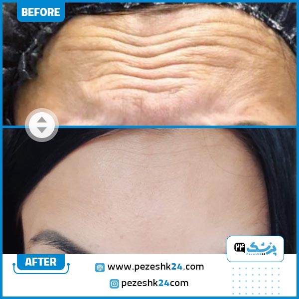 تزریق بوتاکس پیشانی در کلینیک اکسیر
