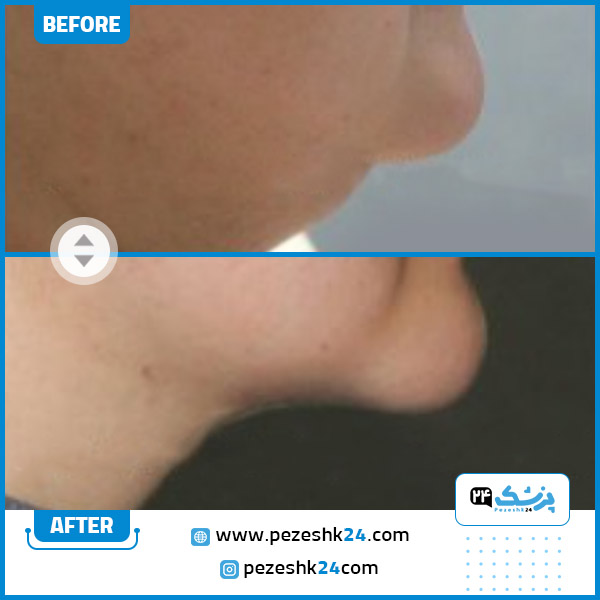 قبل و بعد لیپوماتیک غبغب درکلینیک عرفان