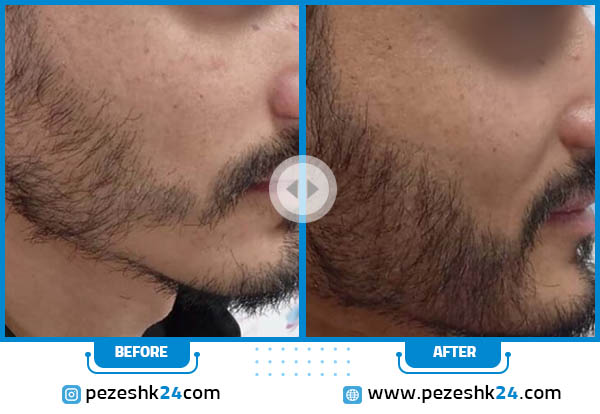 قبل و بعد کاشت ریش در کلینیک اوینا