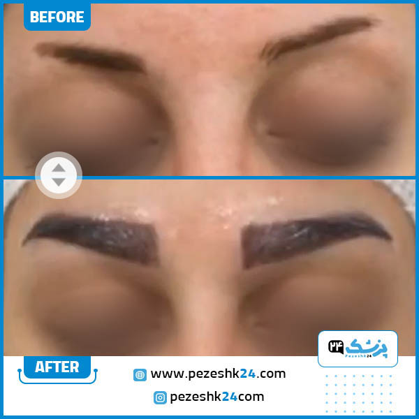 کاشت ابرو در کلینیک اوینا