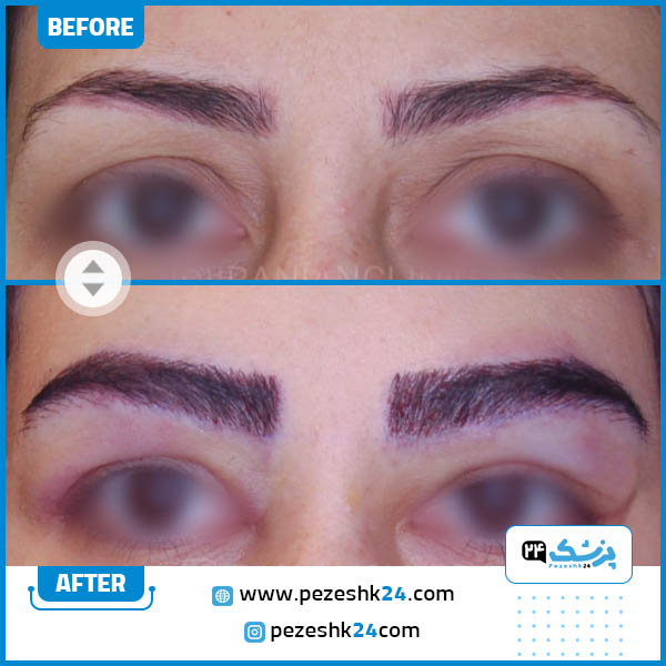قبل و بعد کاشت ابرو درکلینیک ایرانیان