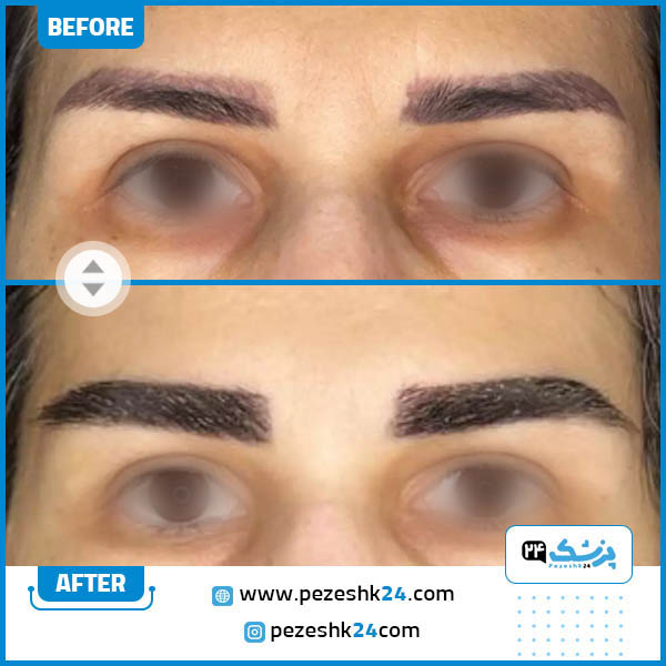 قبل و بعد کاشت ابرو درکلینیک شارمین
