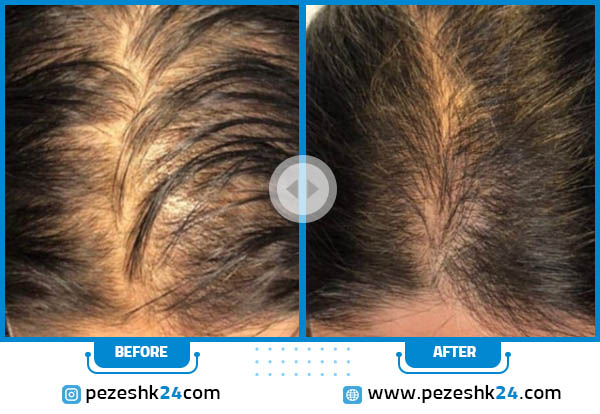 قبل و بعد مزوتراپی مو در کلینیک اکسیر